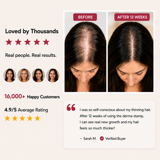 Dermastamp for Hair Growth | Scalp Microneedling Tool
